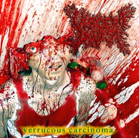 VISCERA INFEST / Verrucous Carcinoma