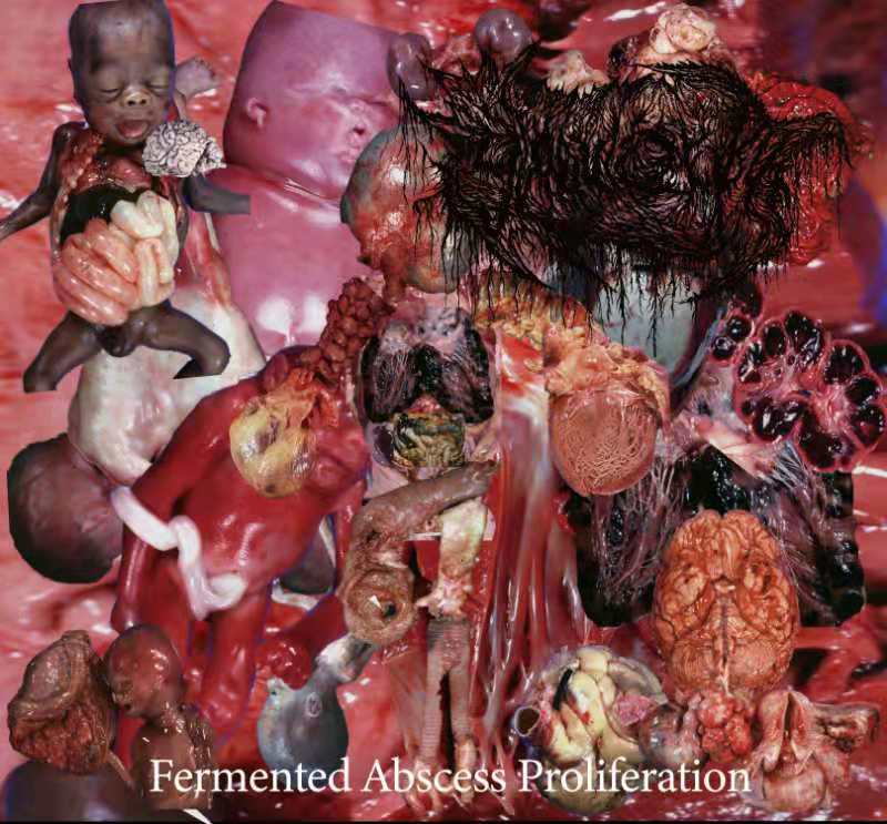 GLOBULARCYST / Fermented Abscess Proliferation