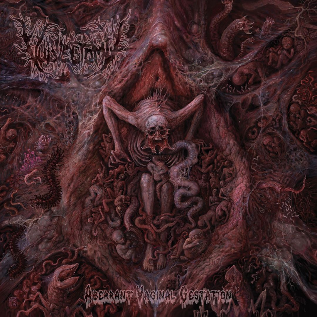 VULVECTOMY / Aberrant Vaginal Gestation